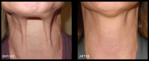 before-after-fibroblast neck(1)