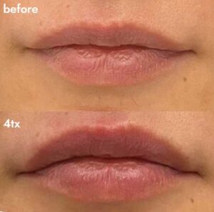 lip-enhancement-2