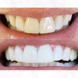 Beige-Before-and-After-Cleaning-Teeth-Instagram-Post-(1)