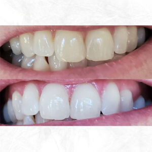 Beige-Before-and-After-Cleaning-Teeth-Instagram-Post-(2)