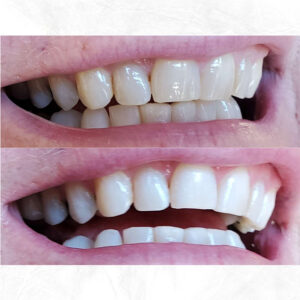 Beige-Before-and-After-Cleaning-Teeth-Instagram-Post-(3)