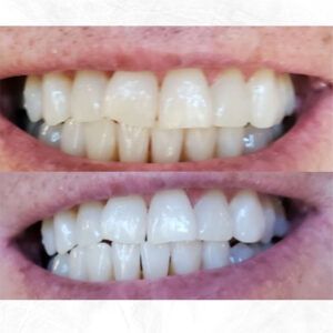 Beige-Before-and-After-Cleaning-Teeth-Instagram-Post-(4)