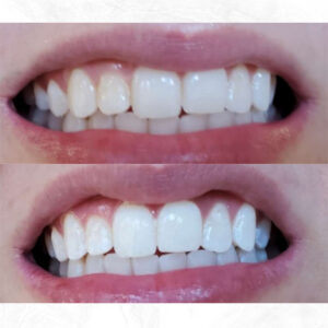 Beige-Before-and-After-Cleaning-Teeth-Instagram-Post-(5)
